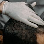 A woman experiencing hair shedding while using weight-loss medication.