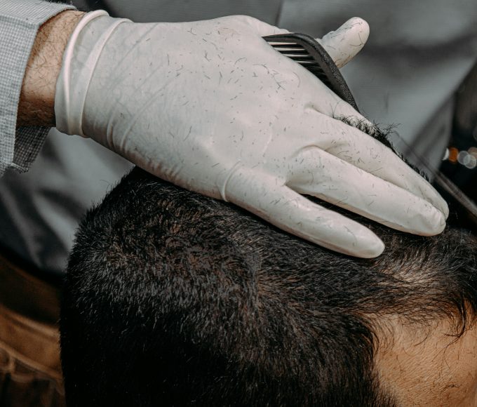 A woman experiencing hair shedding while using weight-loss medication.