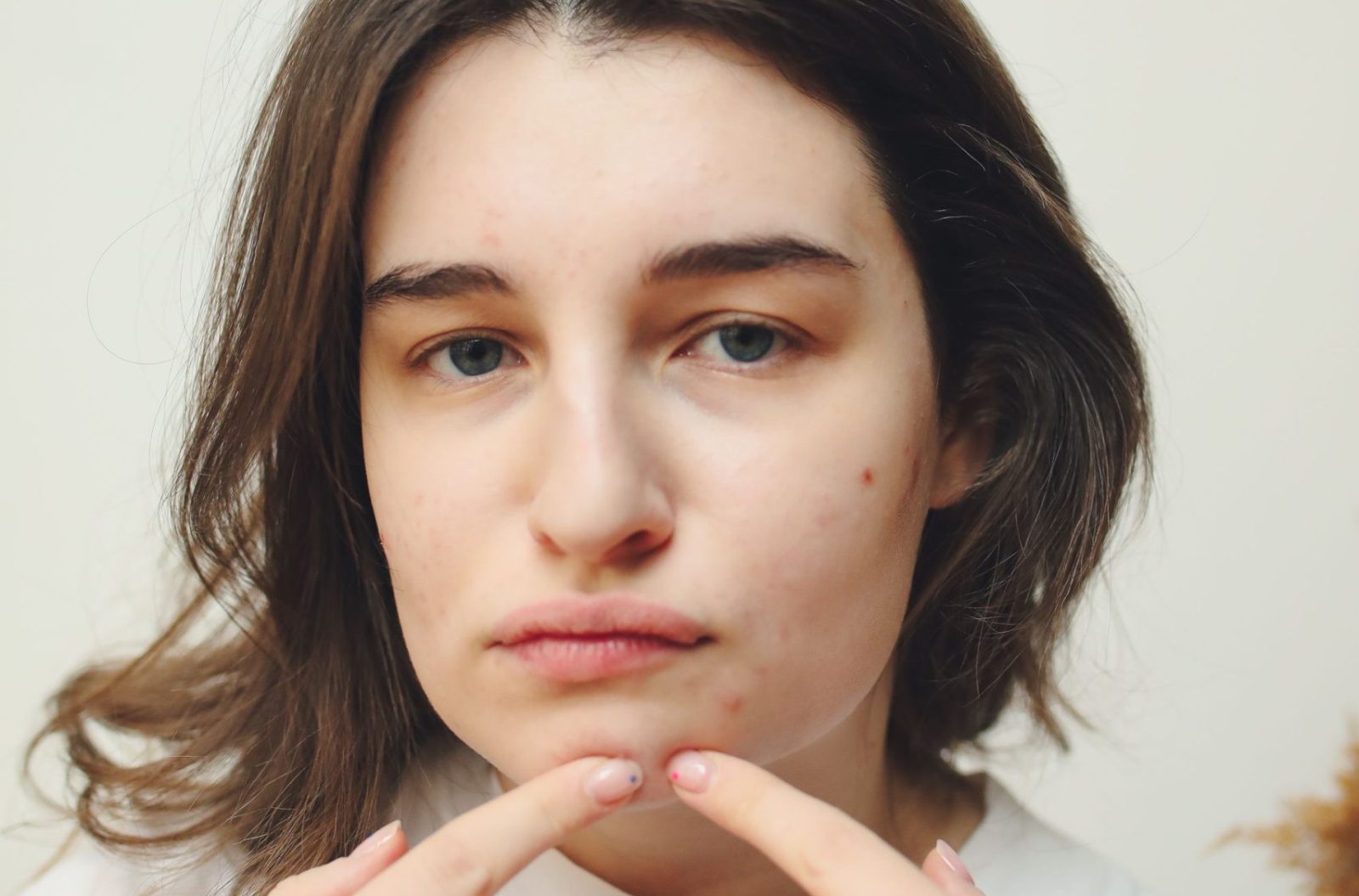 Woman with visible acne applying skincare product to her face