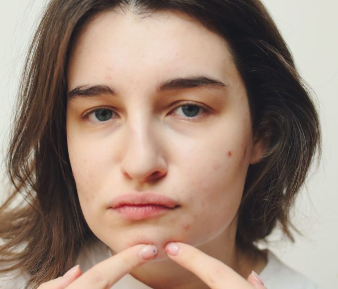 Woman with visible acne applying skincare product to her face
