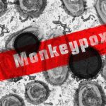 Mpox skin lesions as South Africa records an increase in confirmed cases