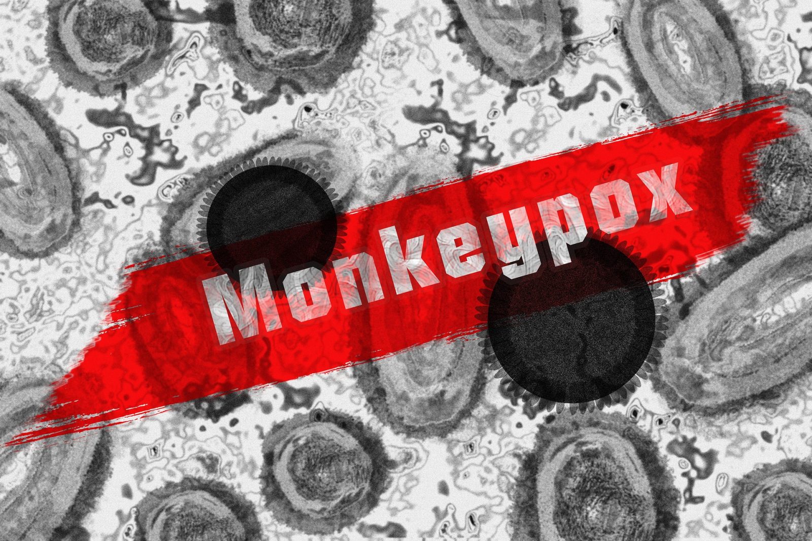 Mpox skin lesions as South Africa records an increase in confirmed cases